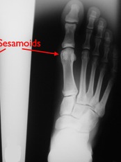 sesamoid example