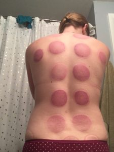 cupping day 1