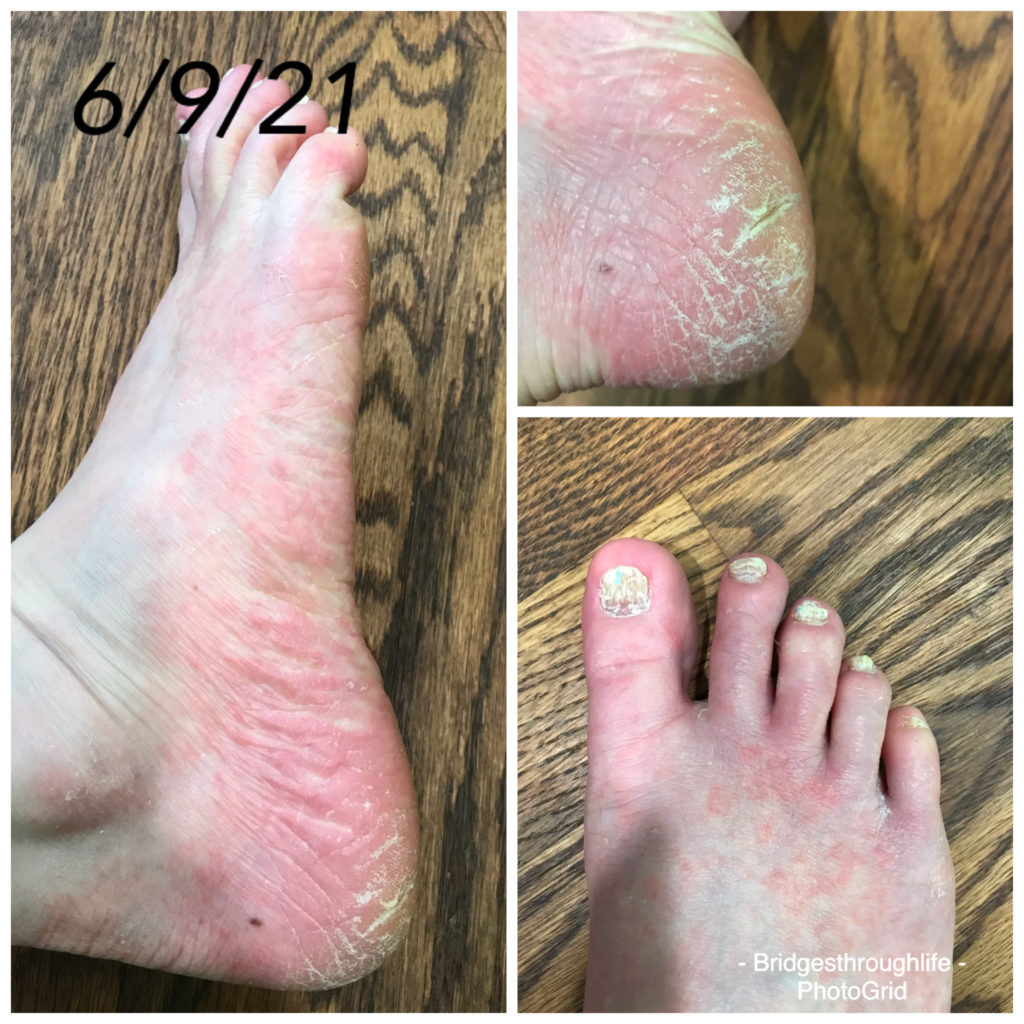 foot fungus start