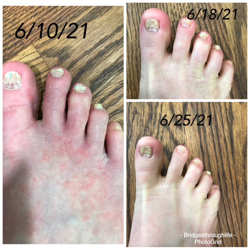 foot fungus 2 weeks